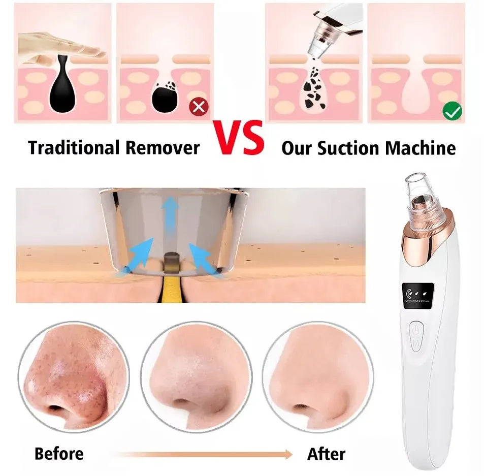5 In 1 Blackhead Remover Machine – Rechargeable Face Vacuum Suction Tool with 5 Interchangeable Heads