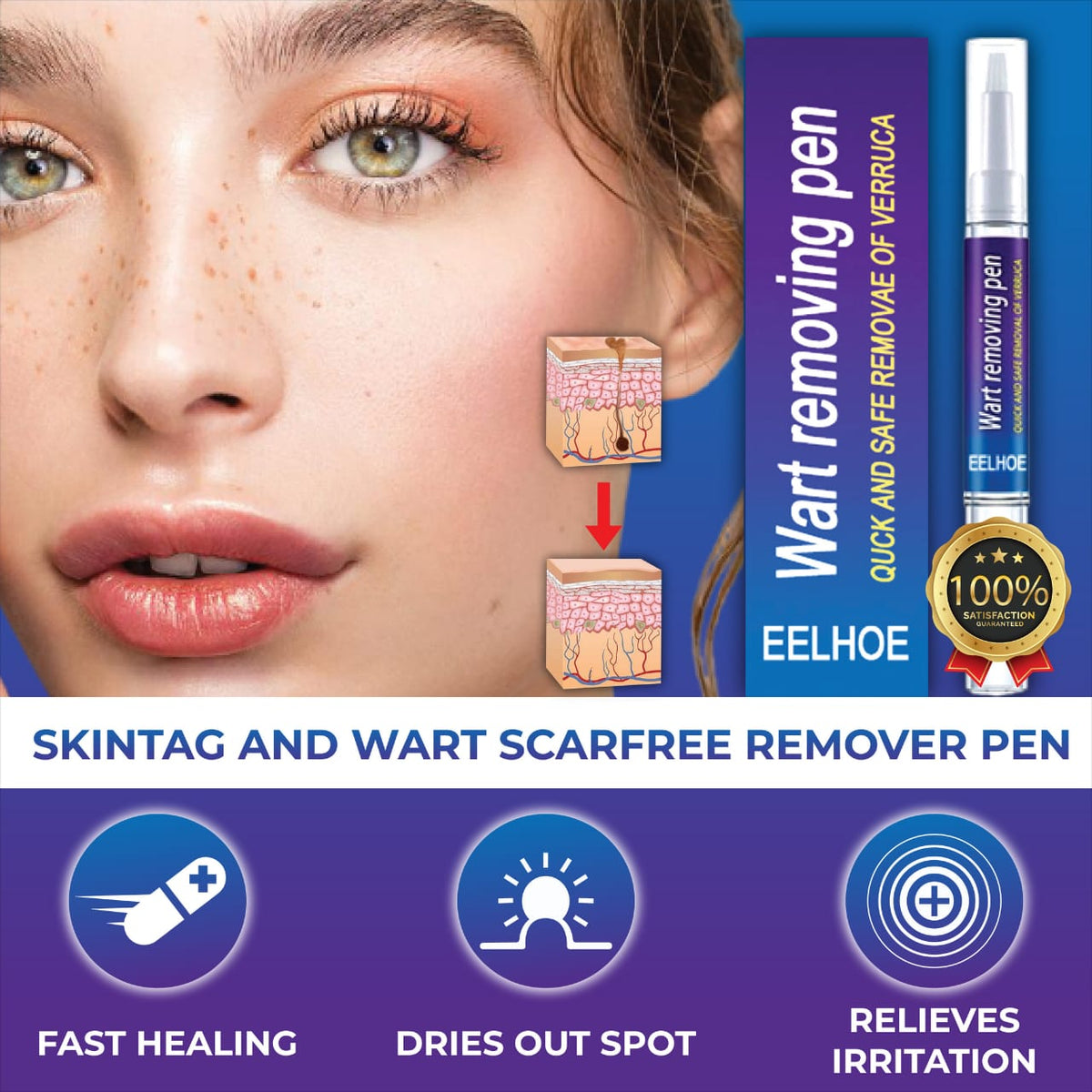 Wart Remover Gel Pen – Powerful Wart Removal Treatment for Hands, Feet & Skin | Wart Care Ointment for Common Warts | Easy Apply Skin Treatment